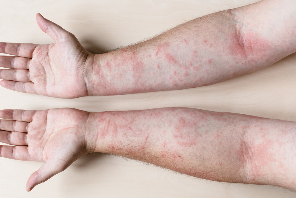 Hives, Fungus and Histamine